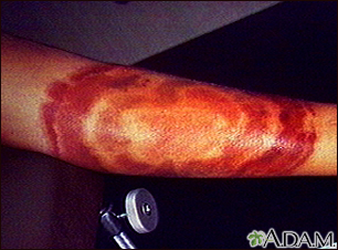 Lyme disease, erythema migrans