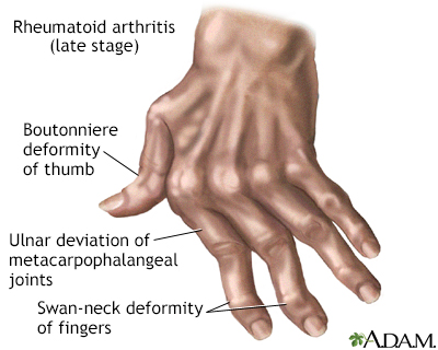 Rheumatoid arthritis képi képek, Röntgen vizsgálatok - Ars Medica Lézerklinika