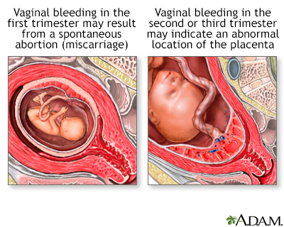 Vaginal Bleeding During Pregnancy