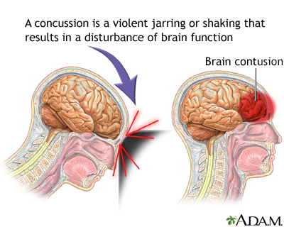 Concussion, Image Source: Penn Medicine