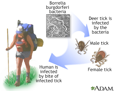 lyme disease transmission symptoms medical ozone tick causes ticks health ask body therapy florida bites adam doctor facts treated where