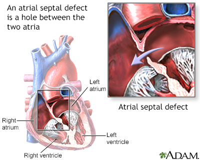 atrial flutter symptoms sweating atrial flutter symptoms sweating