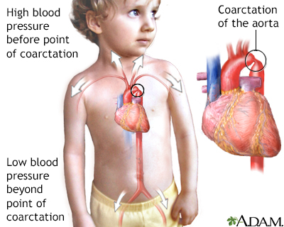 Coarctation Of The Aorta Symptoms And Causes