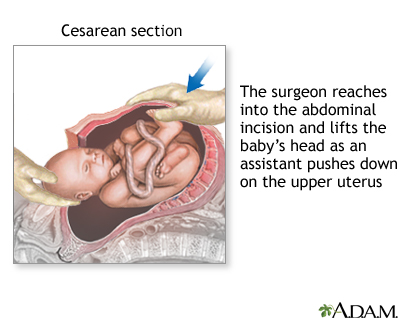 C Section