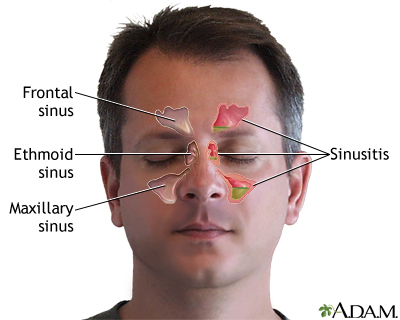 nasal polyps and sinus infection