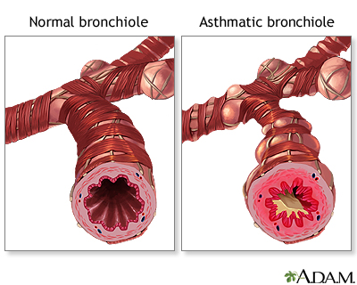 Asthma - Symptoms and Causes