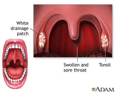 How to ease strep throat pain