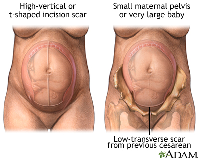 Vaginal Birth After C Section Vbac