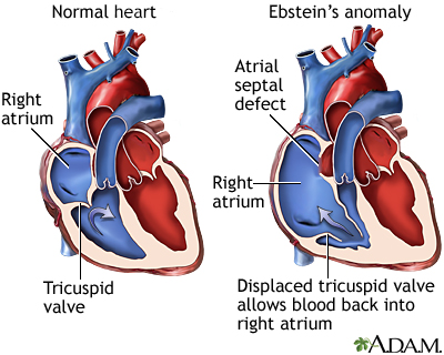 Heart phentermine and leaky valve