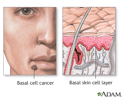 Squamous cell cancer