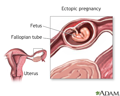 How Do I Know If I Might Have An Ectopic Pregnancy